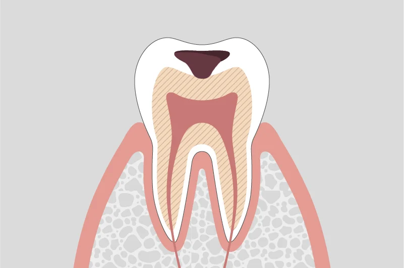 Cavity reaching dentin
