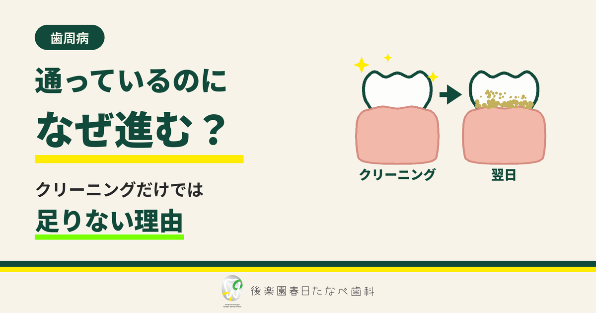 春日・後楽園の歯医者 後楽園春日たなべ歯科 通っているのに歯周病が進む理由（クリーニング当日と翌日の歯）