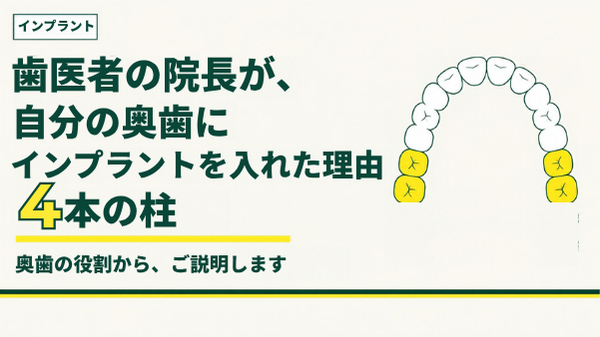 春日・後楽園の歯医者 後楽園春日たなべ歯科 奥歯の4本の柱（第一大臼歯と第二大臼歯）の図